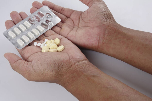 Man with dermatitis problem of rash ,Allergy rash