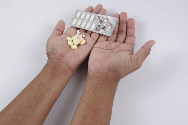 Man with dermatitis problem of rash ,Allergy rash