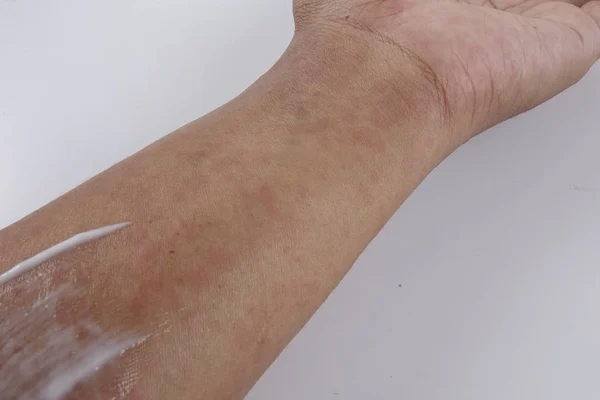 Man with dermatitis problem of rash ,Allergy rash — Stock Photo, Image