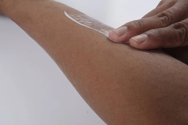 Man met dermatitis probleem van huiduitslag, allergie huiduitslag — Stockfoto