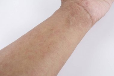 Döküntü, Anti döküntü Dermatit sorunu olan adam