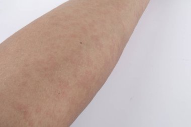 Döküntü, Anti döküntü Dermatit sorunu olan adam