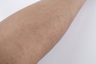 Döküntü, Anti döküntü Dermatit sorunu olan adam