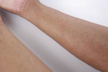 Döküntü, Anti döküntü Dermatit sorunu olan adam