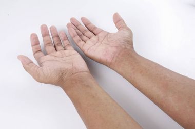 Döküntü, Anti döküntü Dermatit sorunu olan adam