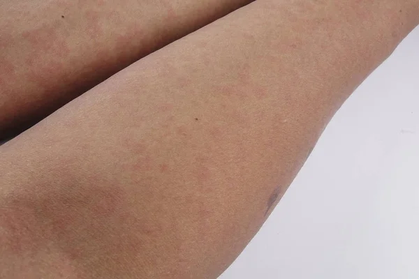 Man met dermatitis probleem van huiduitslag, allergie huiduitslag — Stockfoto