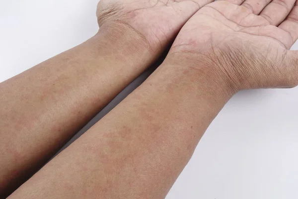 Mann mit Dermatitis Problem von Hautausschlag, Allergie Hautausschlag — Stockfoto