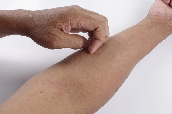 Людина з проблемою дерматиту висипу, алергічна висипка — стокове фото