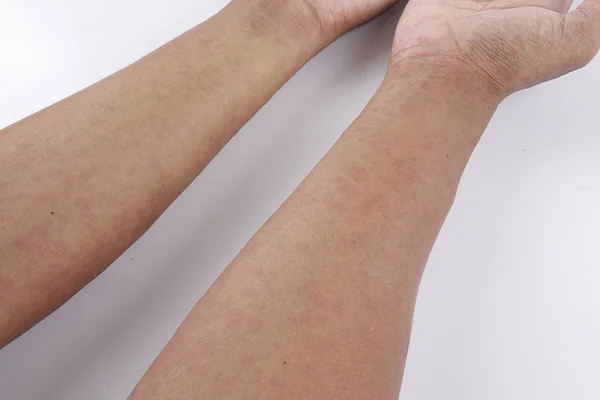 Mann mit Dermatitis Problem von Hautausschlag, Allergie Hautausschlag — Stockfoto