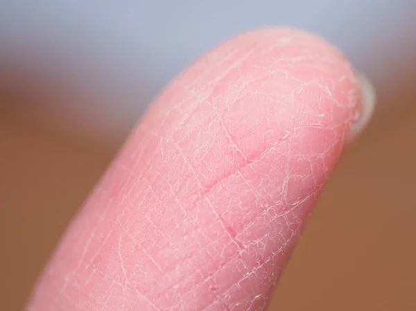 Makro Görüş Altında Iyi Bir Cilt Almadan Kışın Kırılan Parmak — Stok fotoğraf