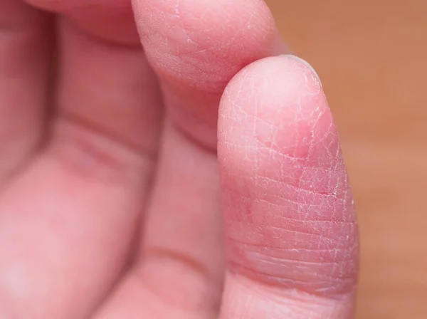 Болезненно Сломанная Кожа Пальца Течение Зимы Принимая Хорошую Кожу Макро — стоковое фото