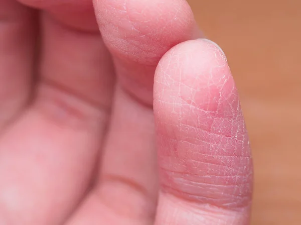 Douloureux Cassé Peau Doigt Pendant Hiver Sans Prendre Bons Soins — Photo