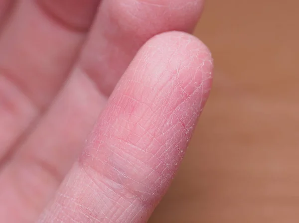 Επώδυνο Σπασμένο Δέρμα Δακτύλων Κατά Διάρκεια Του Χειμώνα Χωρίς Λαμβάνεται Φωτογραφία Αρχείου