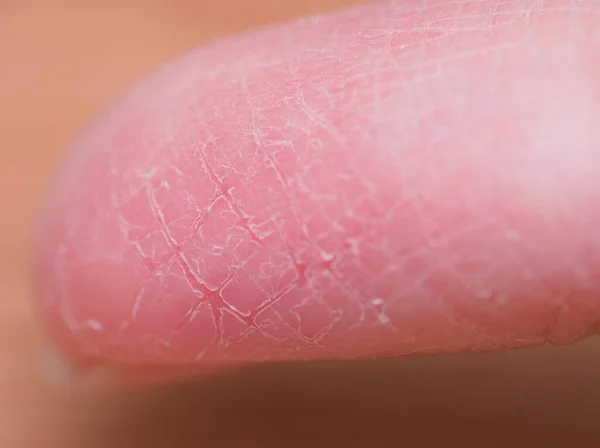 Επώδυνο Σπασμένο Δέρμα Δακτύλων Κατά Διάρκεια Του Χειμώνα Χωρίς Λαμβάνεται Εικόνα Αρχείου