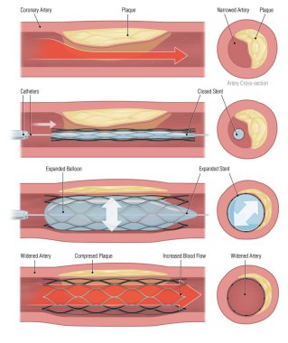Kan dolaşımını destekleyen stent implantasyonu.