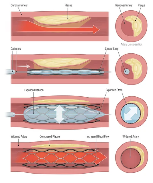Stent Implantatie Voor Het Ondersteunen Van Bloedcirculatie Bloedvaten — Stockfoto