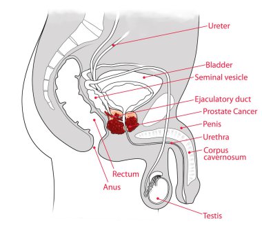 Kanser prostatı anatomisi enine kesit çizimi