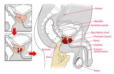 manual examination and cross-sectional view of prostate cancer clipart