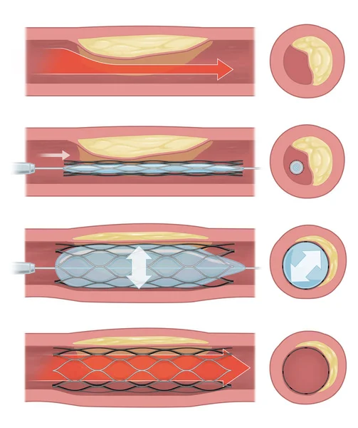 Implantation Endoprothèse Pour Soutenir Circulation Sanguine Dans Les Vaisseaux Sanguins — Photo