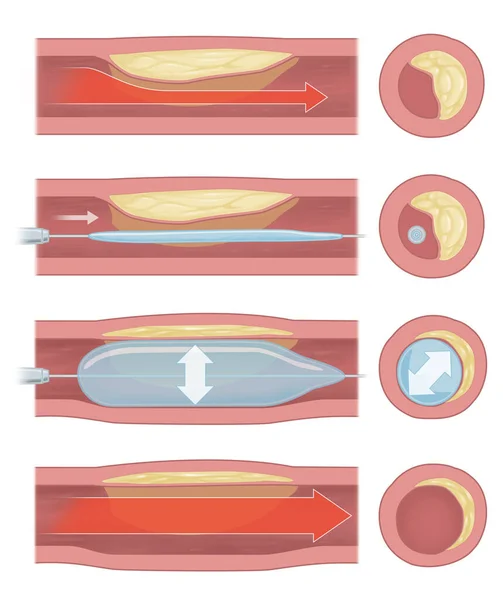 Implantação Balões Para Apoiar Circulação Sanguínea Nos Vasos Sanguíneos — Fotografia de Stock