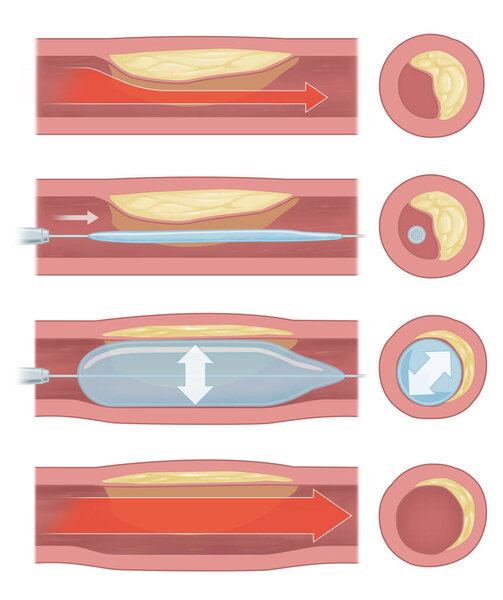 имплантация воздушного шара для поддержания кровообращения в кровеносных сосудах
