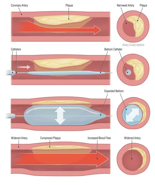 Ballonimplantatie Ter Ondersteuning Van Bloedcirculatie Bloedvaten — Stockfoto