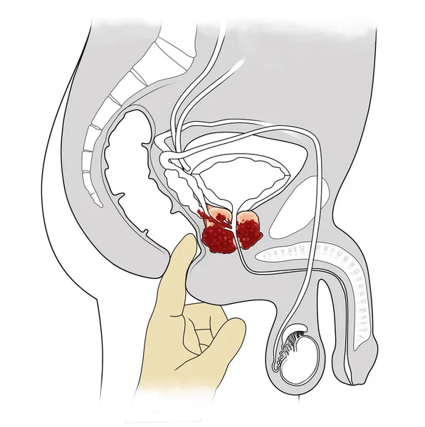 Esame Manuale Visione Trasversale Del Cancro Alla Prostata — Foto Stock