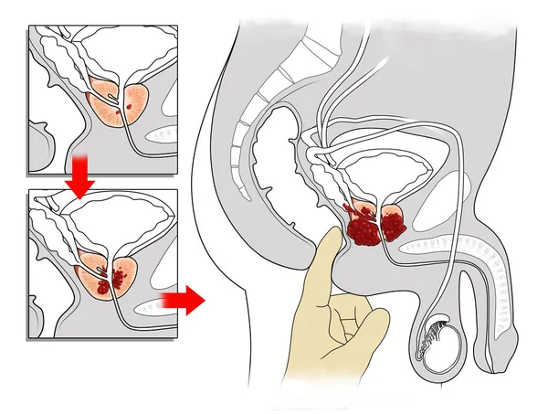 Manuální Vyšetření Průřezový Pohled Karcinom Prostaty — Stock fotografie