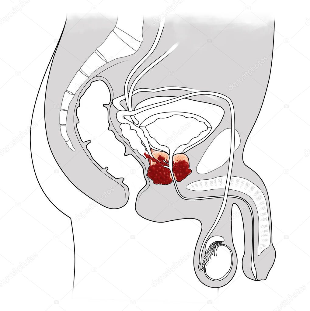 cancer prostate anatomy cross section illustration