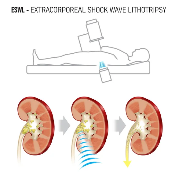 신장결석을 Extracorporeal Shock Wave Lithotripsy Eswl 신장결석을 깨뜨리기 충격파 — 스톡 사진