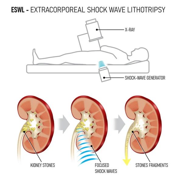Extracorporeal Shock Wave Lithotripsy Eswl Kidney Stones Ondes Choc Pour — Photo
