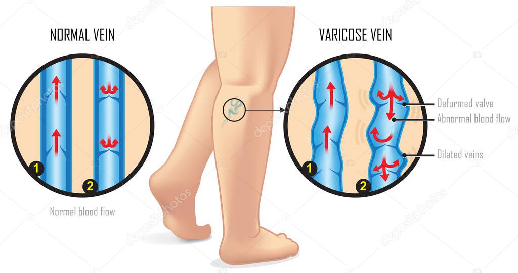 Vector illustration of normal vein and varicose vein anatomy