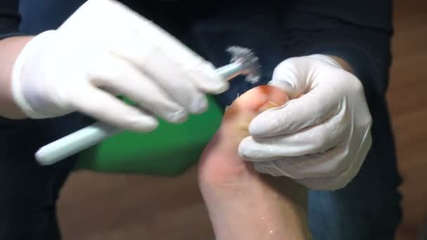 在美容院的修脚过程。emover 在脚上的老茧. — 图库视频影像