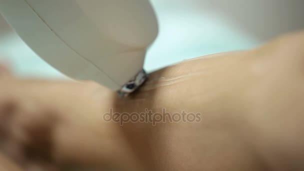 Косметолог делает лазерное удаление волос на ногах пациента. Процедура эпиляции — стоковое видео
