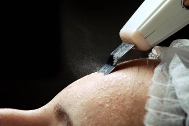 kadın yüz cilt scrubber tedavisi ultrasonik spatula ile