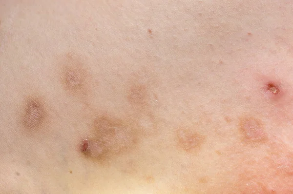 Prurigo. Skin manifestations of a chronic disease with reddish-brown papules, pigmentation sites and crusts after scratching