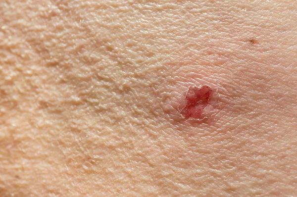 Peau Démangeante Peau Déchirée Site Inflammation Peeling Peignage Peau Avec — Photo