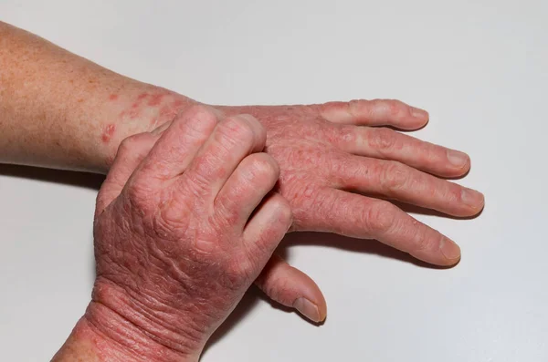 Psoriasispatient Kliar Sig Händerna Klåda Huden Med Kroniska Dermatoser Psoriasis — Stockfoto