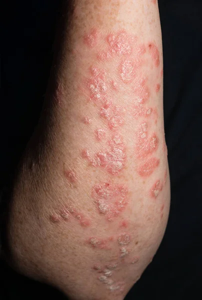 Ontstoken Psoriatische Plaques Witte Huid Van Onderarm Van Vrouw Een — Stockfoto