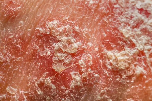 Vulgaris sedef hastalığı. Sedef hastasının derisini yakından çek. Hiperemi, iltihap, soyulma. Makro, alanın derinliği
