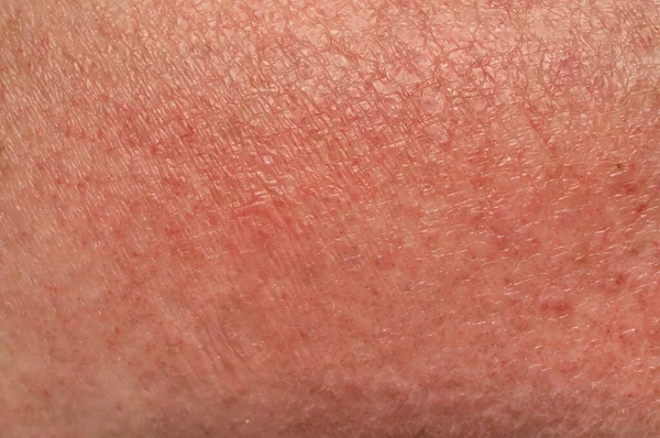 Bőr Megnyilvánulásai Allergiás Reakció Nap Közelről Puha Fókusz Sekély Mélység — Stock Fotó