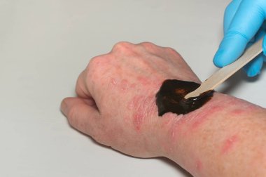 Eldivenli bir doktor, hastanın kolunun hastalıklı derisine spatula sürerek iyileştirici bir merhem sürer. Naphthalan petrolüne dayanan dermatit ve ilaçların tedavisi