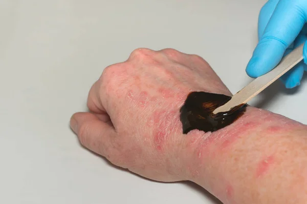 Eldivenli bir doktor, hastanın kolunun hastalıklı derisine spatula sürerek iyileştirici bir merhem sürer. Naphthalan petrolüne dayanan dermatit ve ilaçların tedavisi