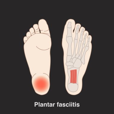 Vector hand drawn flat illustration plantar fasciitis infographic for medical studies. Isolated on black background. clipart