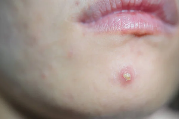 Young woman with acne problem,Close up of acne on the face skin caused by the hormone and the scars, acne inflammation .