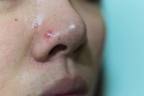 有痤疮问题的年轻妇女 因激素和疤痕导致面部皮肤痤疮闭锁 痤疮发炎 — 图库照片