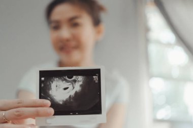 Hamile bir kadın 4 haftalık röntgen taramasına bakıyor.