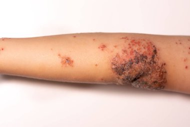 Bir çocuğun kolunda impetigo.