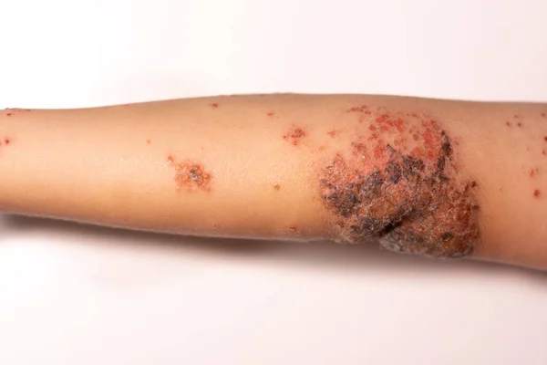 Bir çocuğun kolunda impetigo.