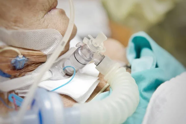 Paciente hace traqueostomía y ventilador en el hospital — Foto de Stock